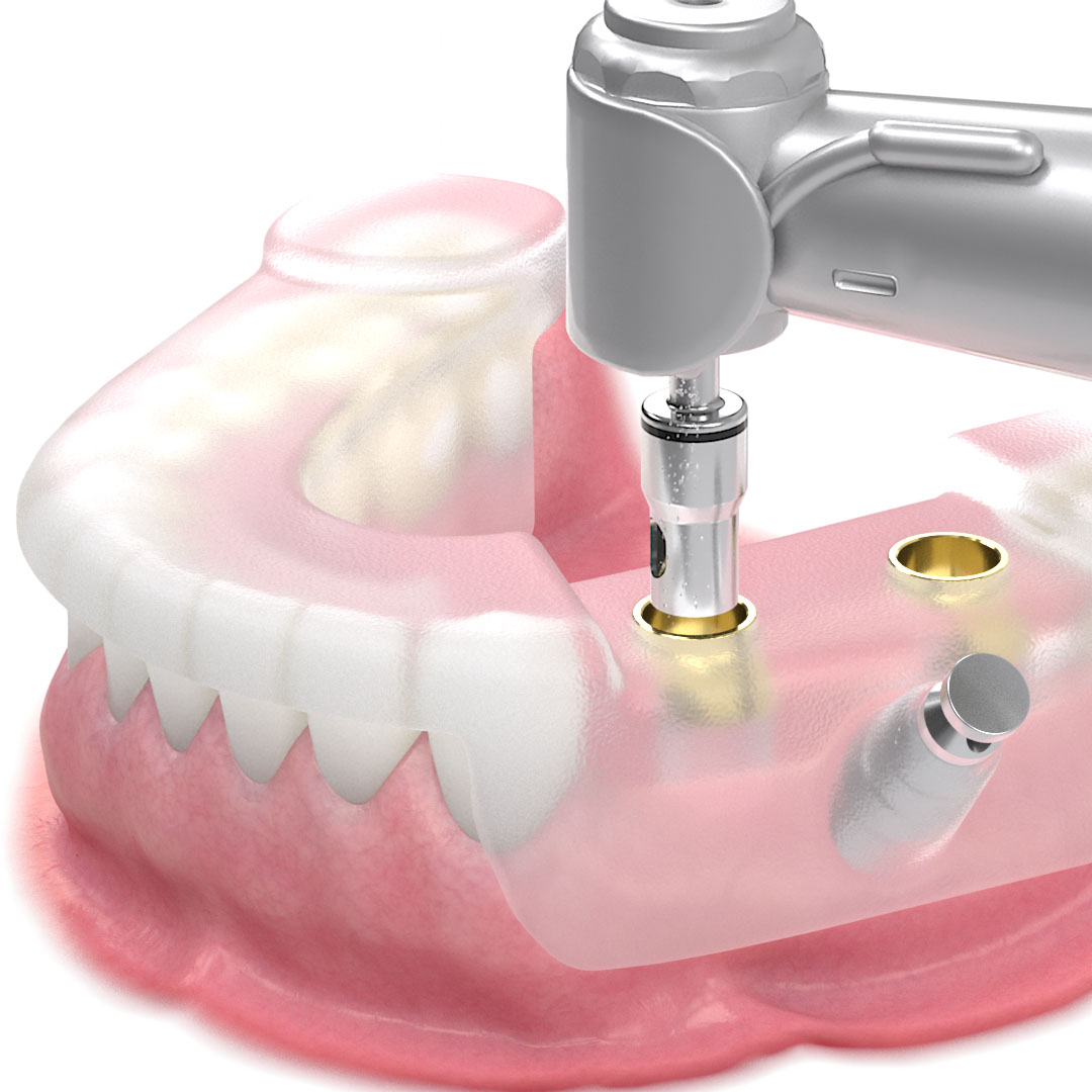 A 3D image showing implant surgery guided by a surgical guide. After the plastic guide is fixed, a dental drill precisely creates a hole in the gum at the correct location and depth.
