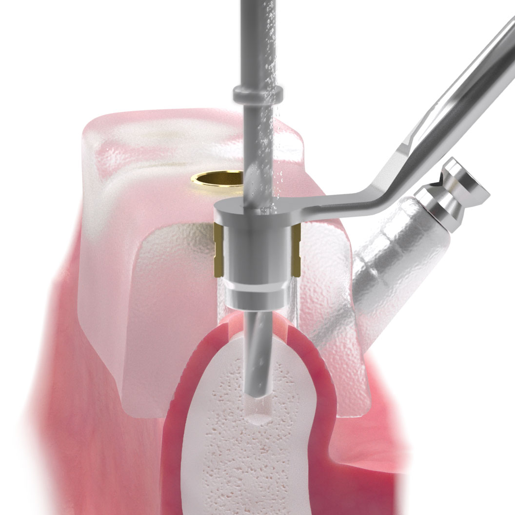 A 3D cross-sectional image of a tooth and gum during implant surgery, showing how the surgical guide enables precise hole placement without deviation.