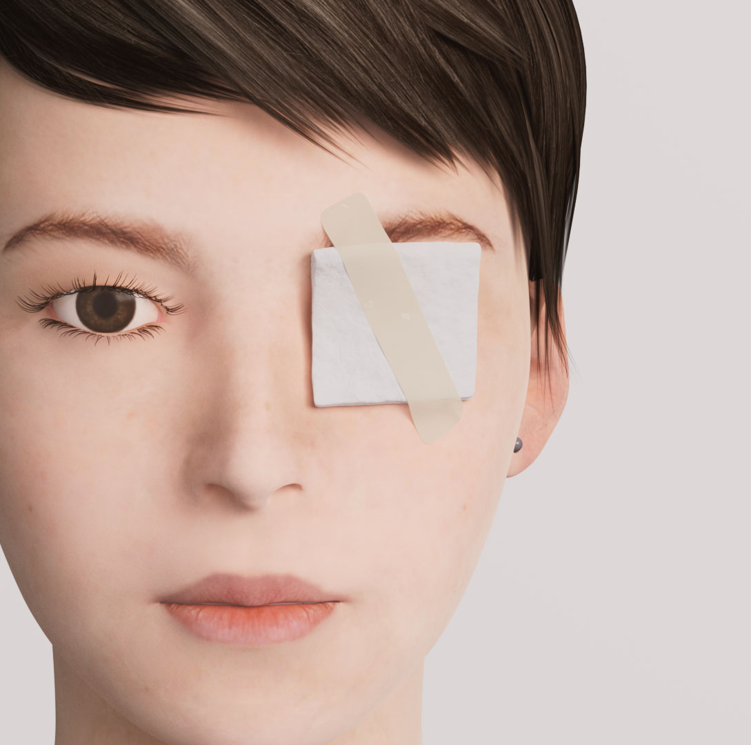 A 3D illustration showing eye protection with gauze after eyelid or lacrimal duct treatment, allowing the eye to rest and recover.