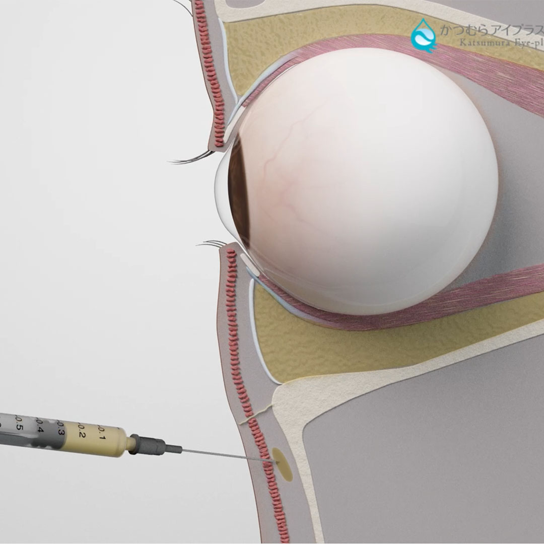 A 3D image depicting fat injection into the area under the eye affected by Baggy-Eyelid.