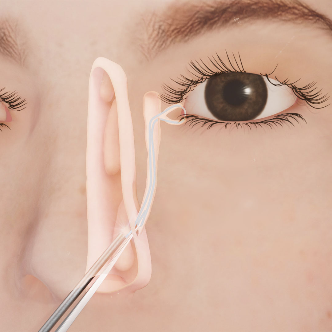 A 3D visualization of the surgical procedure during lacrimal duct obstruction treatment.