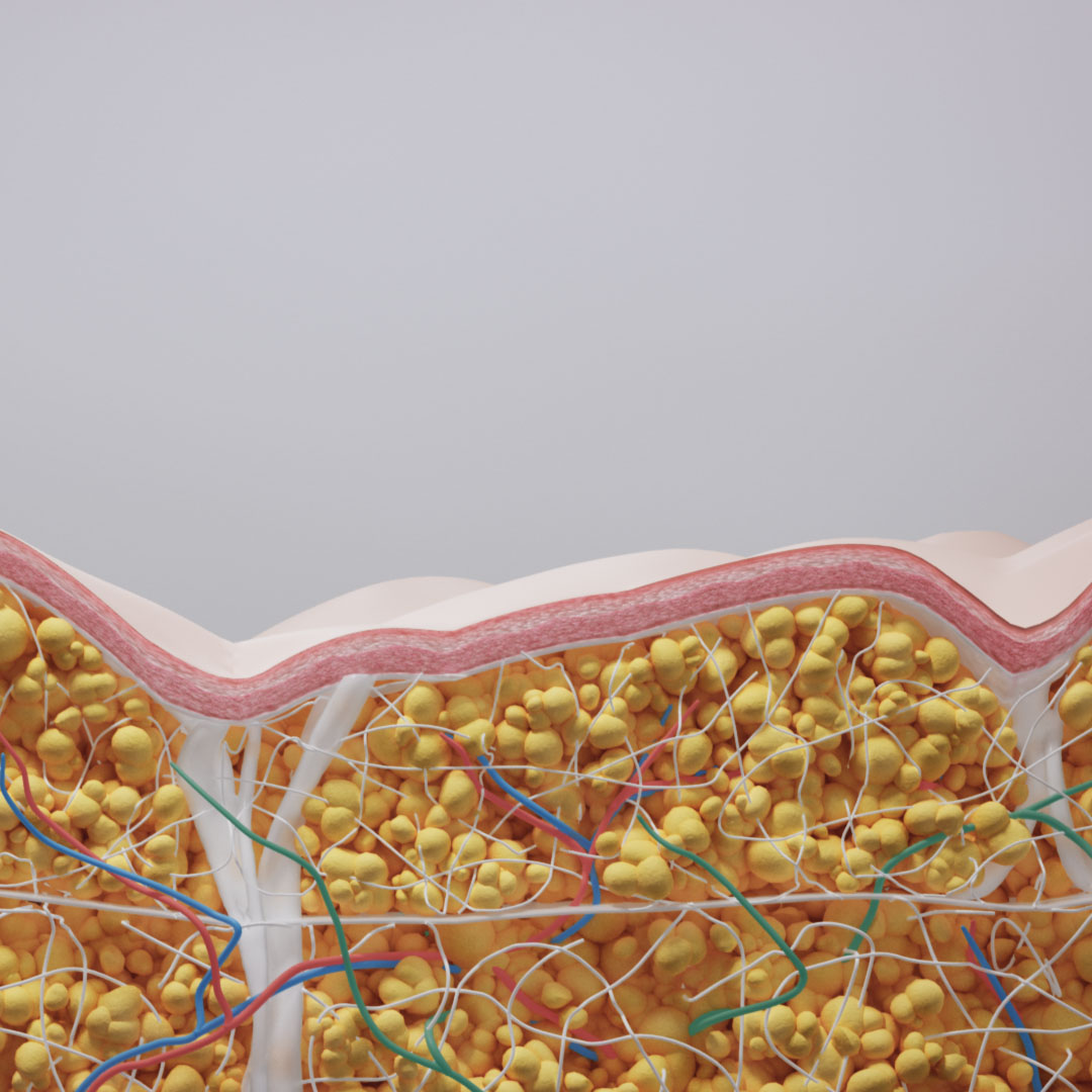 A 3D visualization beneath the skin of a lipedema patient, showing fat divided into two layers, blood vessels and lymphatic vessels running intricately between them.