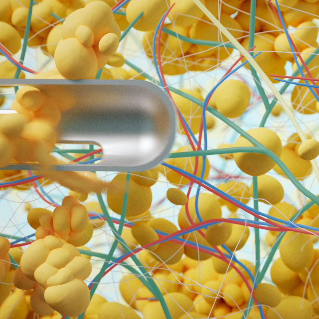A 3D rendering of liposuction during lipedema treatment, carefully avoiding blood vessels and other structures.